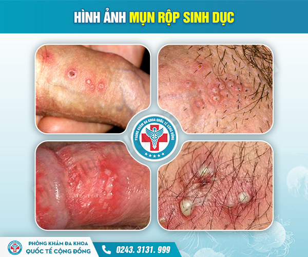Mụn rộp sinh dục