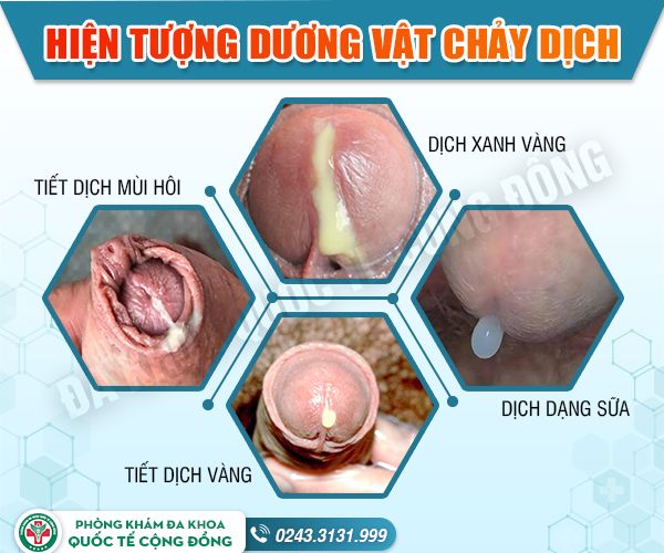 Vùng kín bị chảy dịch- bạn đã biết cách chữa chưa?