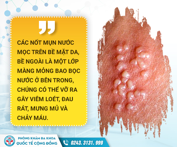 Mụn nước dương vật: Hỗ trợ điều trị sớm trước khi quá muộn