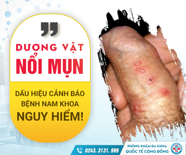 Chớ chủ quan với triệu chứng mụn trắng ở dương vật