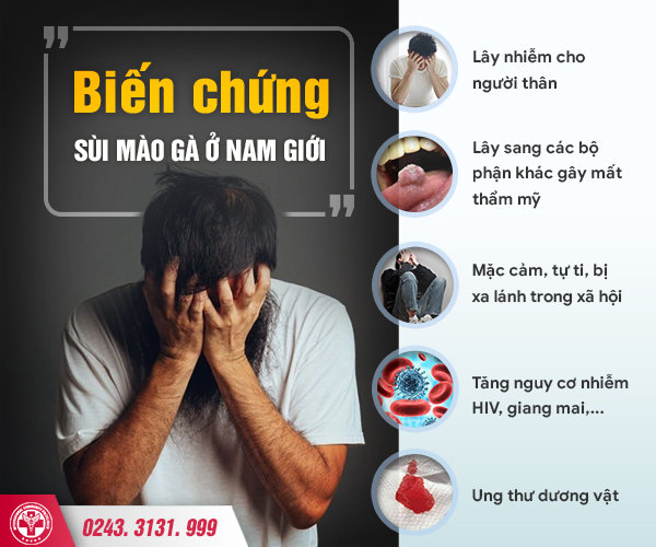 IRA & Ala-Pdt 3 – 2 cách chữa sùi mào gà tốt nhất hiện nay 