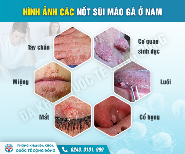 Những triệu chứng sùi mào gà ở nam giới cần đi khám ngay