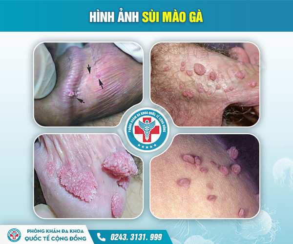 Bảo vệ sức khỏe sinh sản: Đừng bỏ qua những nốt mụn trắng ở dương vật