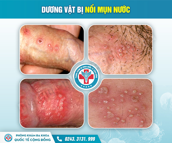 Mụn nước ở dương vật – Bệnh lý cực kỳ nguy hiểm với “cậu bé”