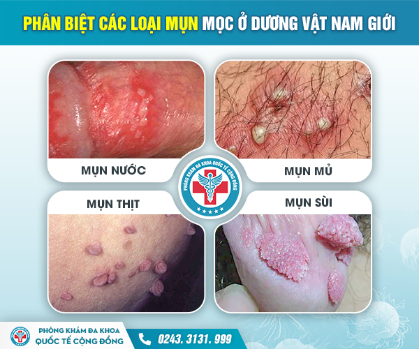 Dương vật nổi mụn – Nỗi “ám ảnh” kinh hoàng của cánh mày râu