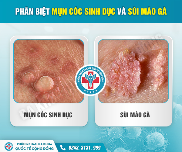 Mụn cóc sinh dục ở nam giới là bệnh gì? Không chữa bệnh có được không?