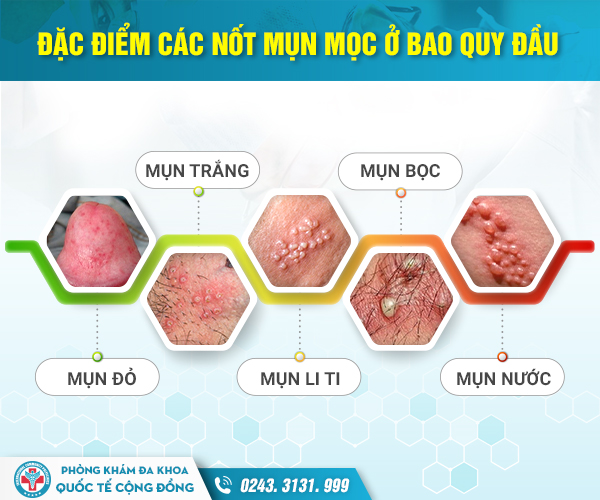Dương vật nổi mụn đỏ: Đừng đợi đến khi lan rộng, viêm loét – tái phát mới đi khám